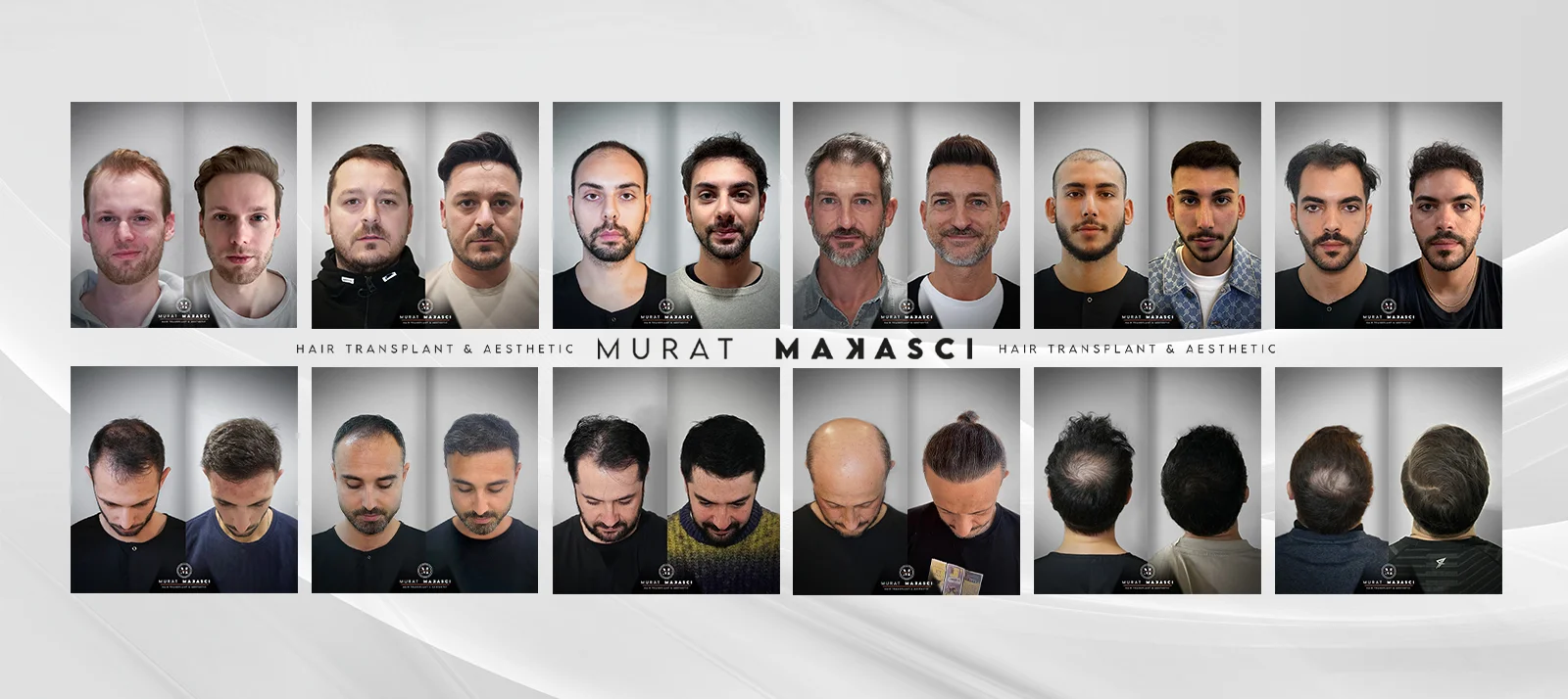 Murat Makascı Saç Ekimi Sonuçları